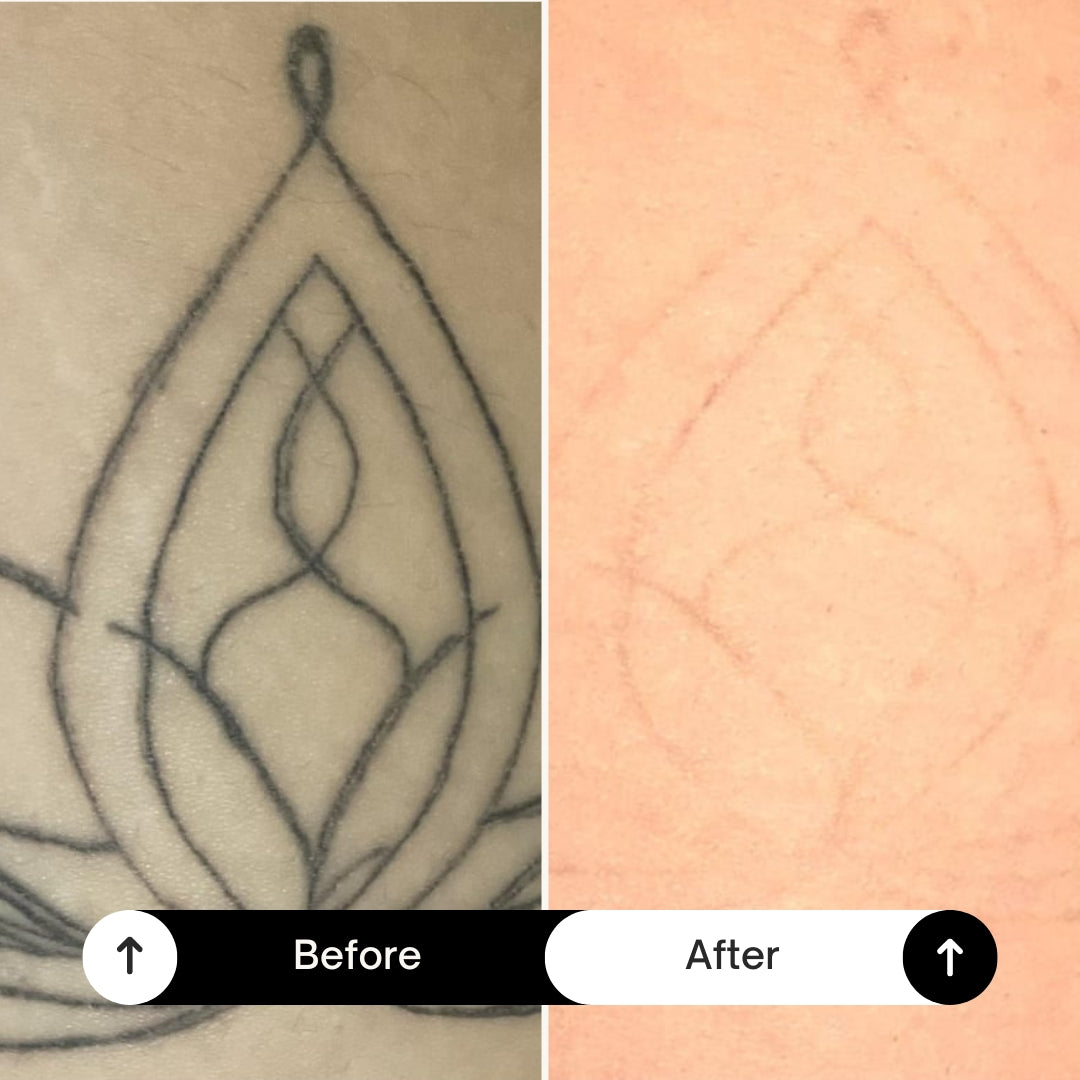 BubblPro™: Picosecond Laser Tattoo Removal