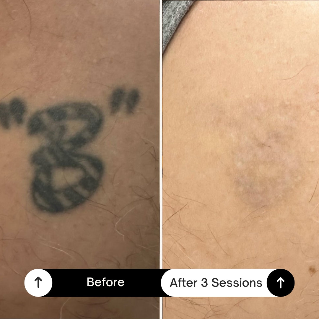 BubblPro™: Picosecond Laser Tattoo Removal