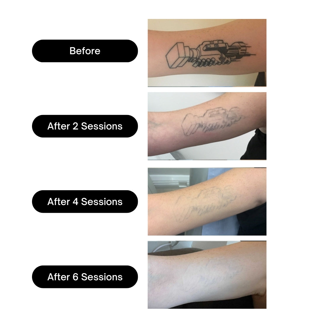 BubblPro™: Picosecond Laser Tattoo Removal