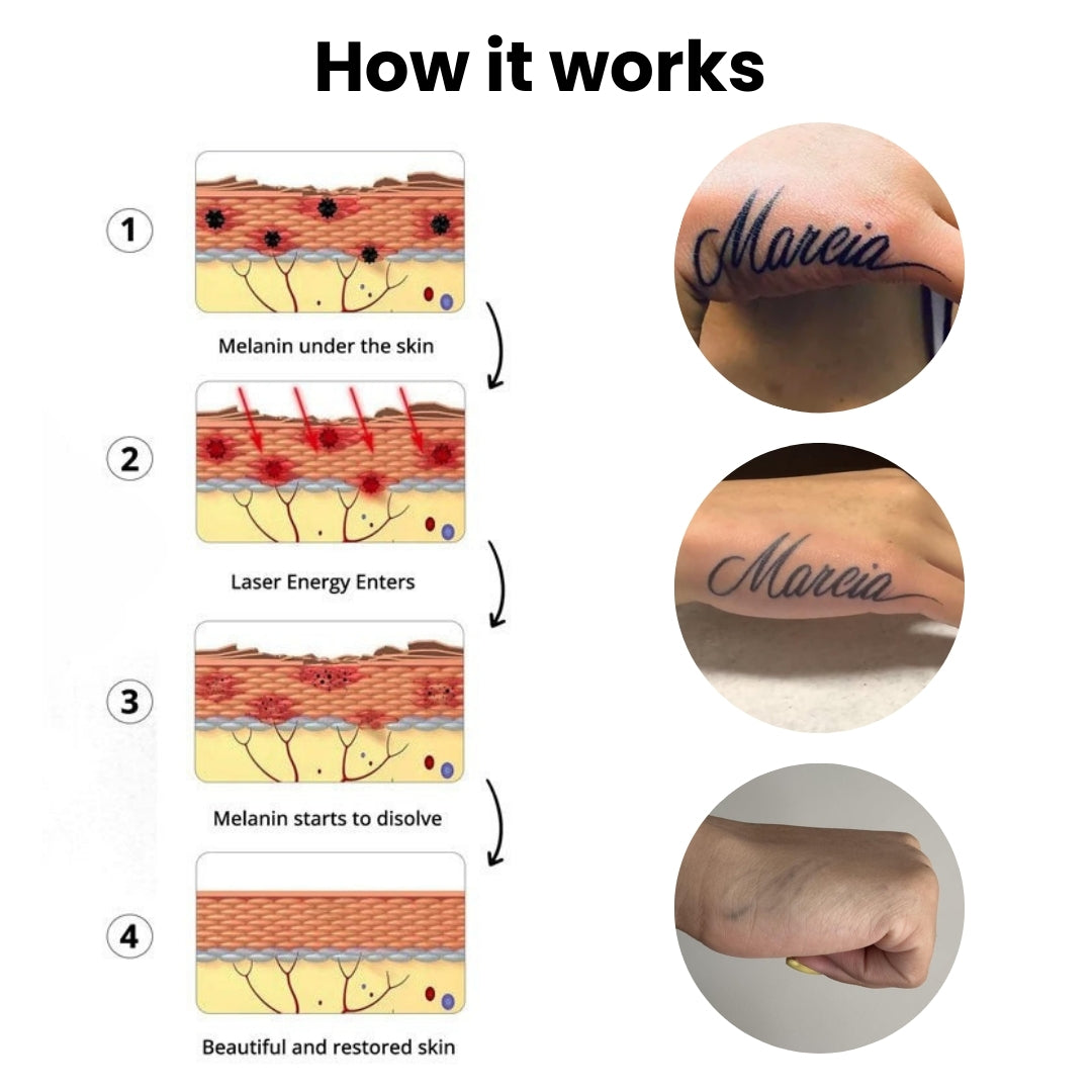 BubblPro™: Picosecond Laser Tattoo Removal