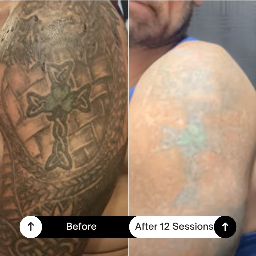 BubblPro™: Picosecond Laser Tattoo Removal
